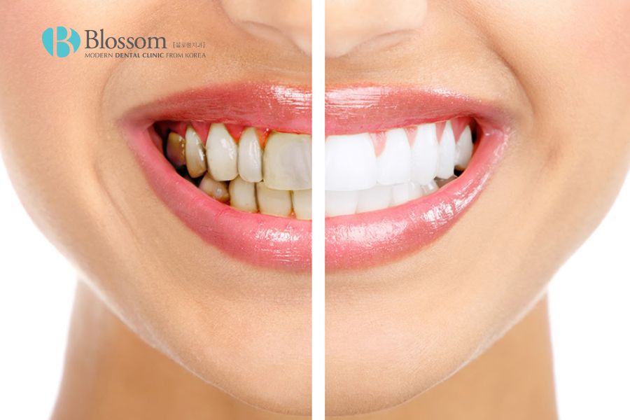 Tẩy trắng răng là cách đơn giản và hiệu quả để bạn có nụ cười tỏa nắng.