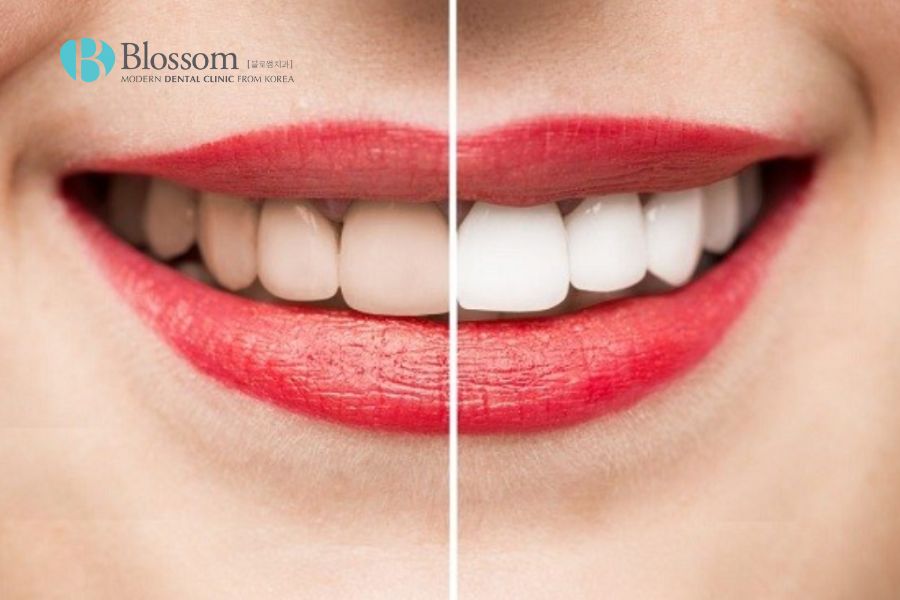 Tẩy trắng răng tại Blossom giúp mang đến hàm răng trắng sáng, đều màu.