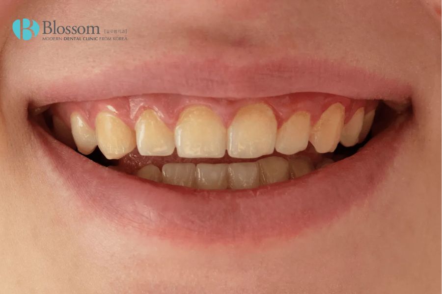 Theo nha sĩ chuyên khoan, có nhiều nguyên nhân dẫn đến tình trạng răng ố vàng.