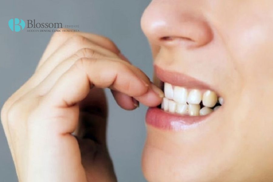 Thói quen cắn móng tay từ nhỏ có thể gây hô răng.
