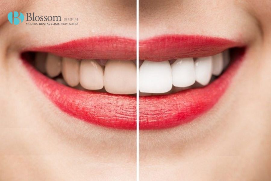 Thuốc tẩy trắng răng giúp mang đến hàm răng trắng sáng rất nhanh chóng