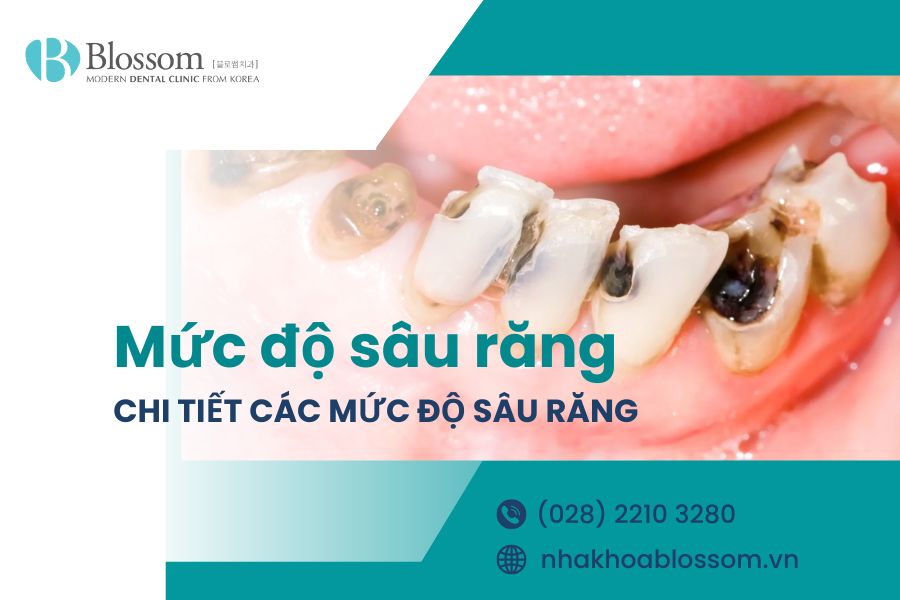 Tìm hiểu chi tiết các mức độ sâu răng trong nha khoa