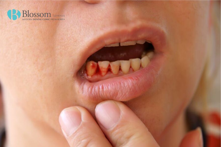 Tình trạng chảy máu chân răng xuất hiện ở mọi lứa tuổi