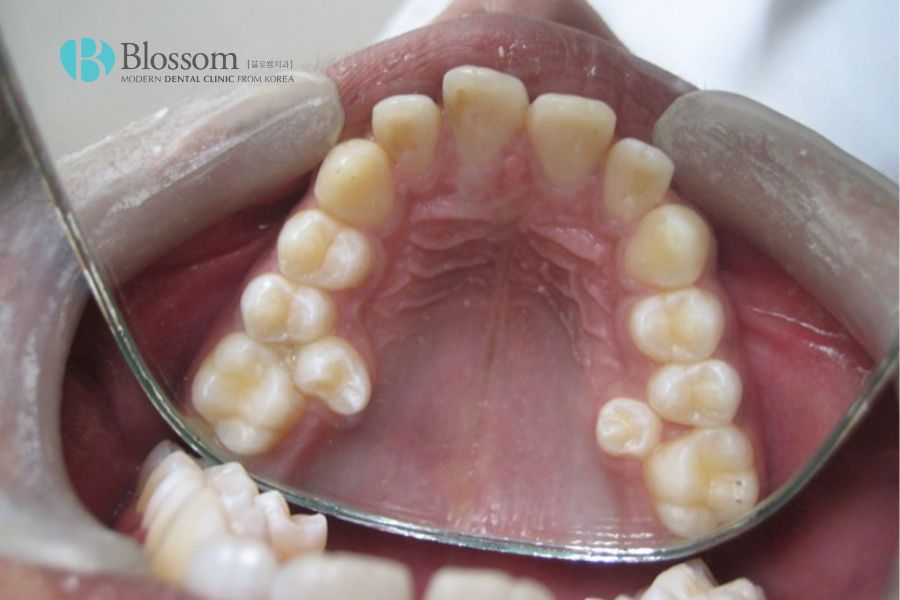 Tình trạng răng dư đôi khi vẫn xuất hiện trong nha khoa.