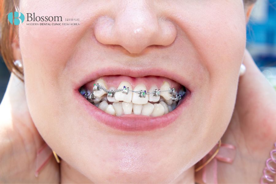 Tình trạng răng mọc không đều nên thực hiện niềng răng trước khi tiến hành dán sứ