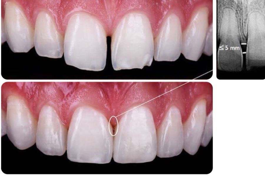 Trám răng giúp cải thiện tình trạng răng thưa một cách hiệu quả.