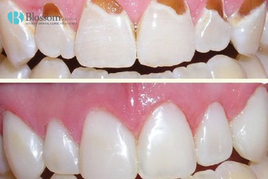 Trám răng là biện pháp chữa mòn cổ chân răng tương đối hiệu quả.