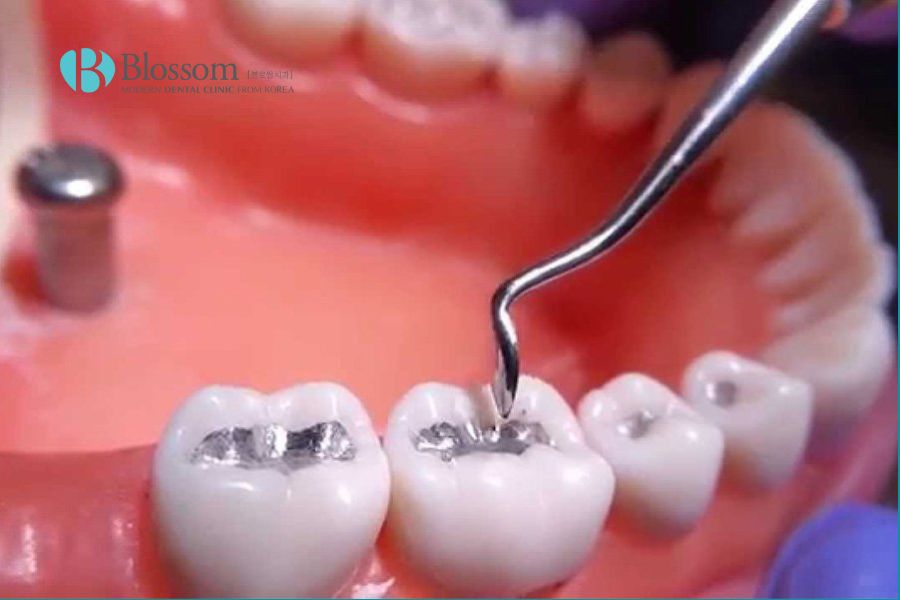 Trám răng là kỹ thuật nha khoa được sử dụng để điều trị và ngăn ngừa sâu răng phát triển.