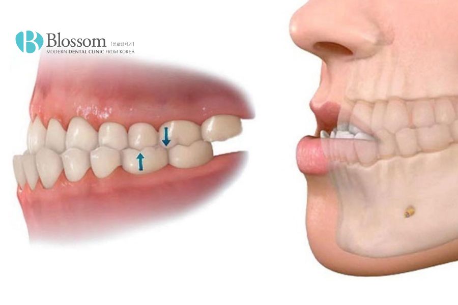 Trong nhiều trường hợp, răng không không cần niềng mà có thể áp dụng nhiều phương pháp khác.