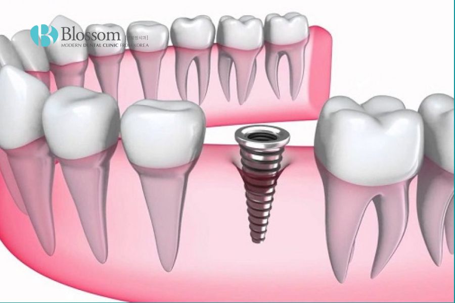 Trụ Implant cắm trực tiếp vào xương hàm tạo sự vững chắc cho răng Implant
