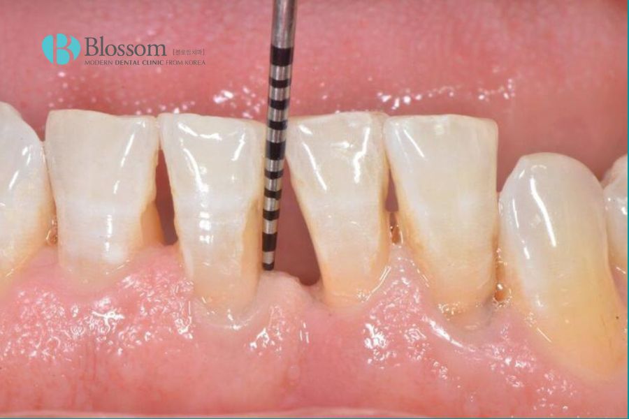 Tụt nướu chỉ xảy ra ở một hoặc một vài răng và nướu vẫn có khả năng bám lại vào chân răng