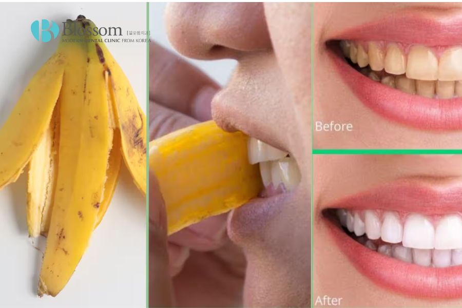 Vỏ chuối có tác dụng tuyệt vời giúp làm trắng răng bị ố vàng nhẹ