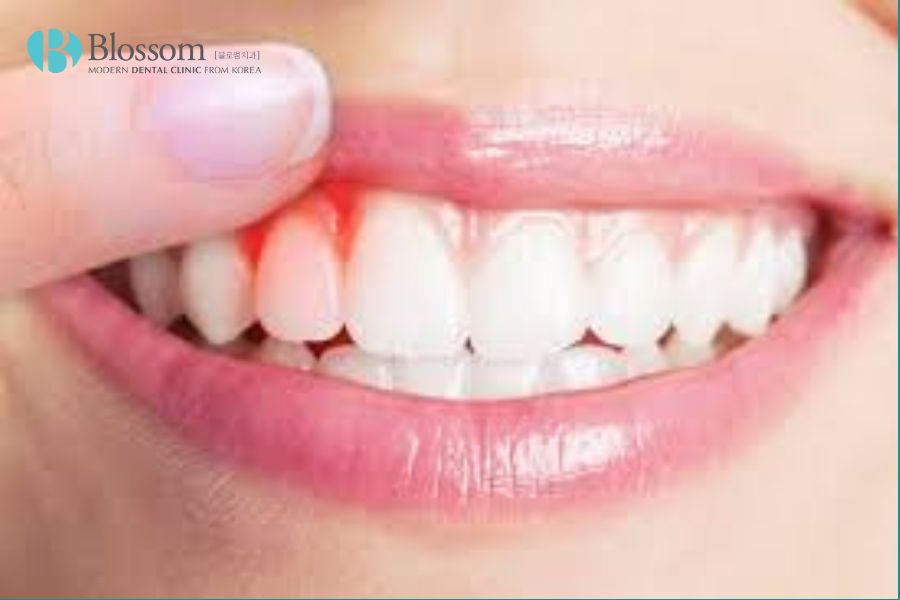 Bệnh viêm nha chu là một căn bệnh nguy hiểm có thể dẫn đến mất răng.