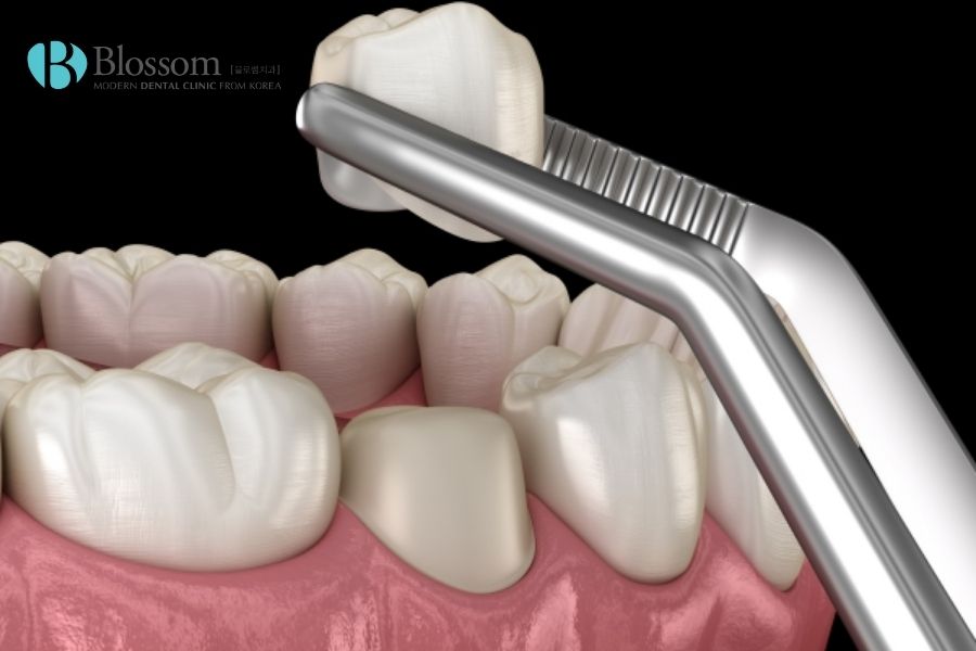 Bọc răng sứ cần mài chỉnh bề mặt của răng thật dưới 2mm