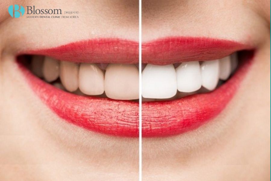 Bọc răng sứ là phương pháp khắc phục răng bị xỉn màu nặng.