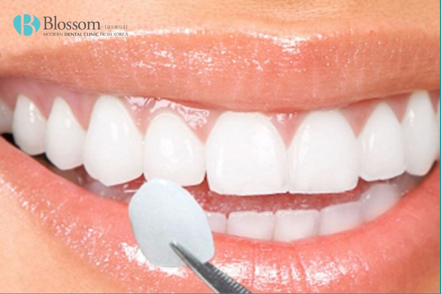 Bọc răng sứ là phương pháp thẩm mỹ nha khoa phù hợp cho những trường hợp răng vẩu nhẹ.