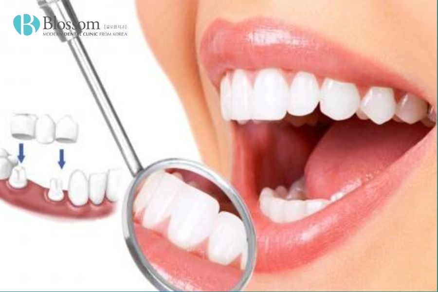 Bọc răng sứ phù hợp với những trường hợp răng móm nhẹ và không có các vấn đề về khớp cắn.