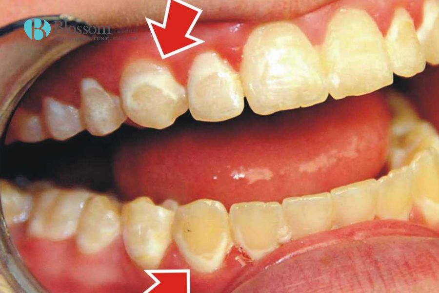 Các dấu hiệu mòn men răng rất dễ nhận biết.