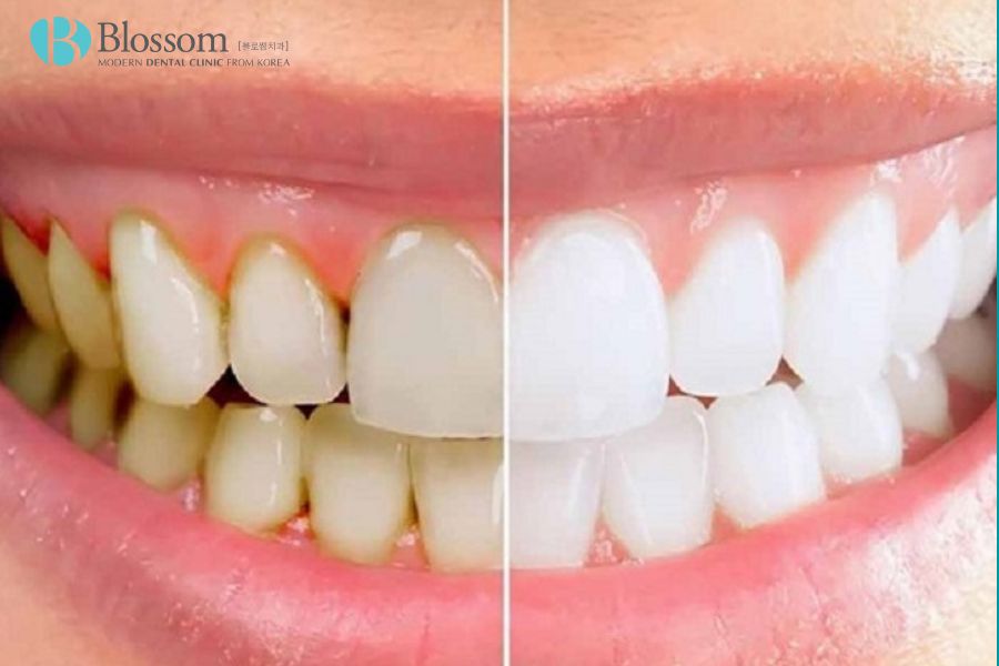 Cạo vôi răng giúp giảm nguy cơ bị bệnh răng miệng, giúp răng trắng sáng, khỏe mạnh.