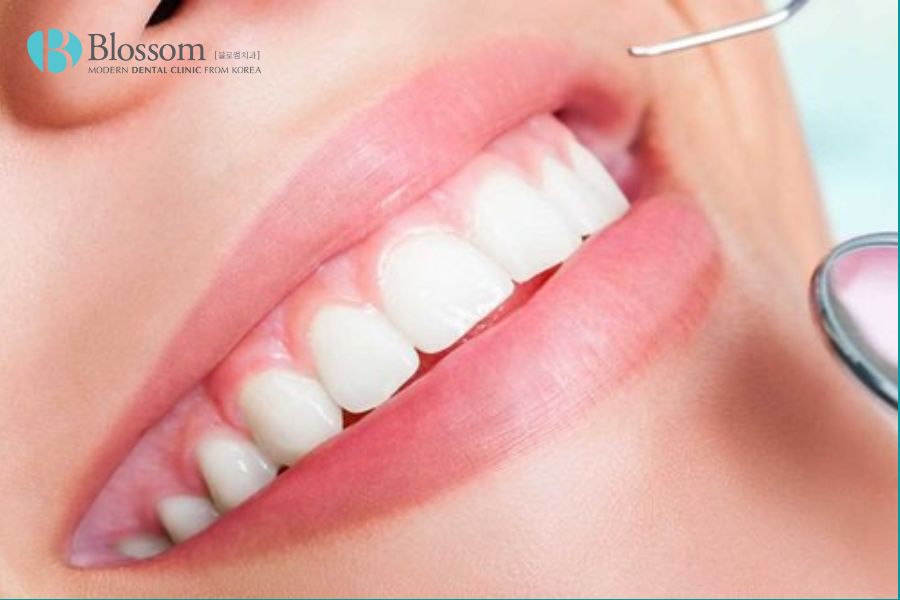 Cạo vôi răng giúp loại bỏ vi khuẩn gây hại và bảo vệ sức khỏe của xương hàm và răng.