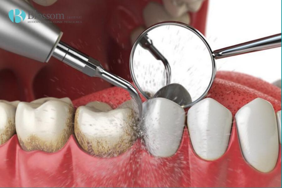 Cạo vôi răng là phương pháp nha khoa nhằm loại bỏ mảng bám và vôi răng tích tụ trên bề mặt răng.