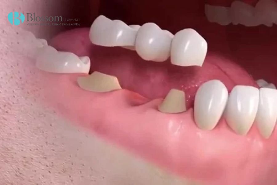 Cầu răng sứ dễ vệ sinh và cố định, khó bị lung lay
