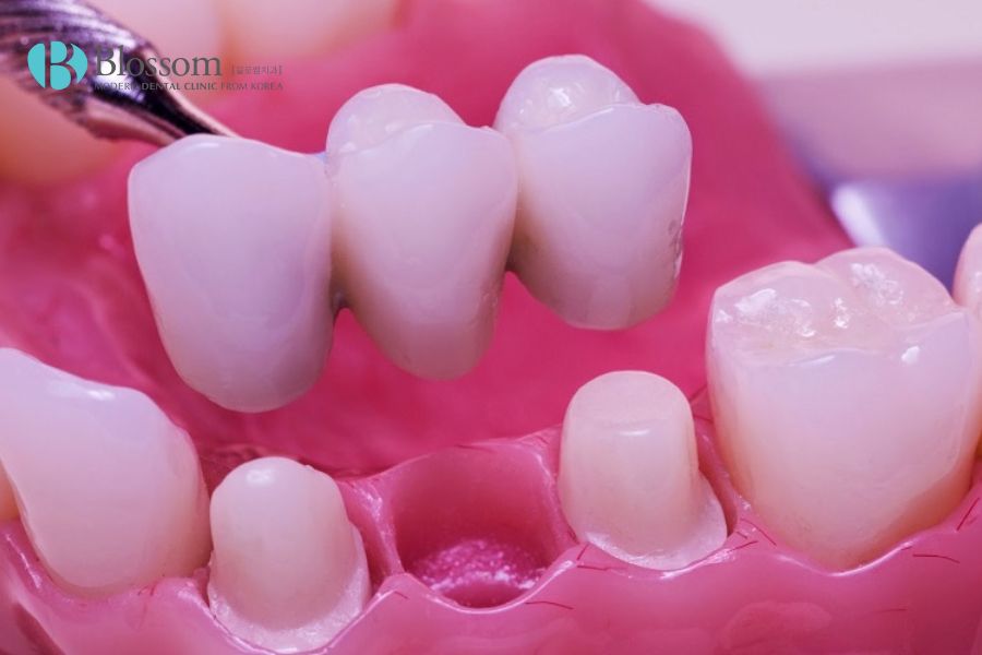 Cầu răng sứ hỗ trợ khôi phục chức năng ăn nhai ở người lớn tuổi