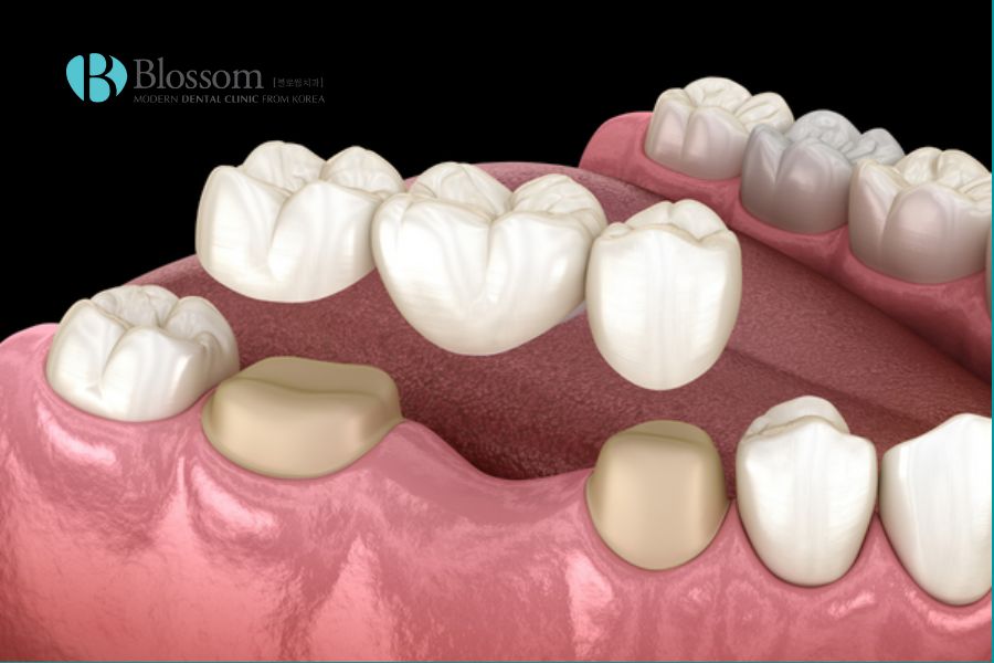 Cầu răng sứ là phương pháp phục hình răng hiệu quả cho trường hợp mất một hoặc vài răng liền kề.