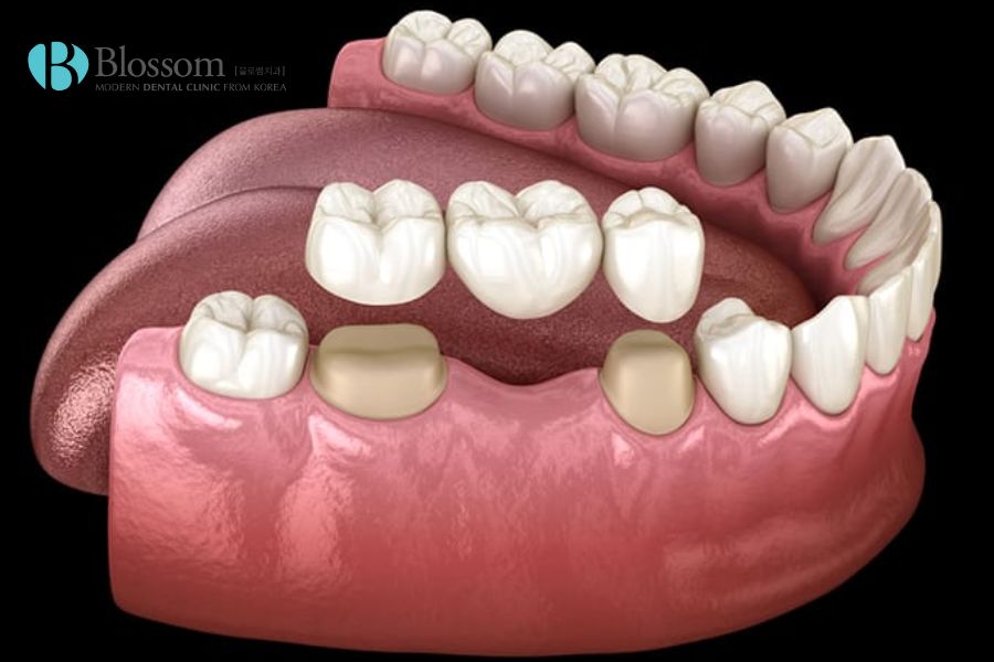 Cầu răng sứ là phương pháp trồng răng giả cố định áp dụng cho trường hợp mất một hoặc vài răng