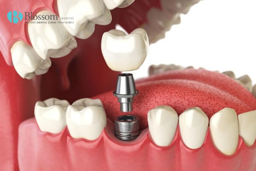 Cấy ghép Implant - một phương pháp giải quyết hiệu quả vấn đề mất răng hàm lâu năm phổ biến