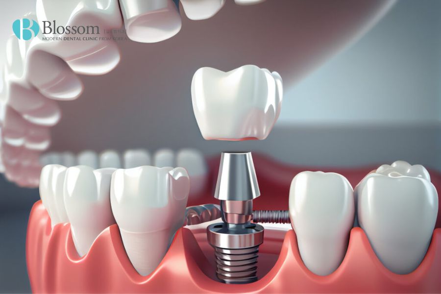 Cấy ghép Implant vừa cải thiện chức năng ăn nhai, vừa gia tăng tính thẩm mỹ cho răng