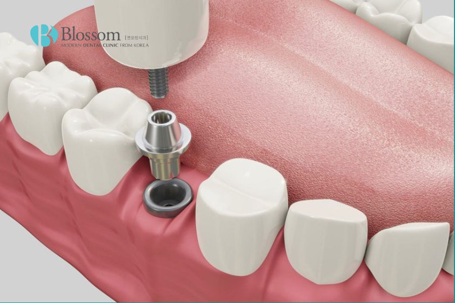 Cấy ghép răng sứ trên Implant là giải pháp phục hình răng toàn diện.