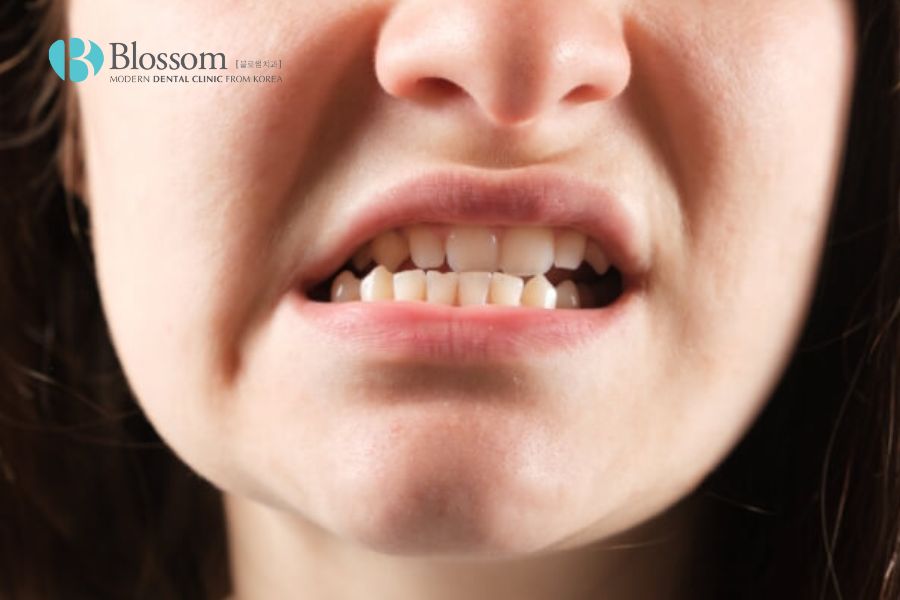 Chấn thương có thể khiến răng lệch hàm.