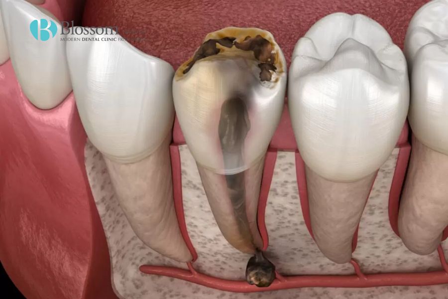 Chết tủy răng khiến răng đổi màu từ sâu bên trong.