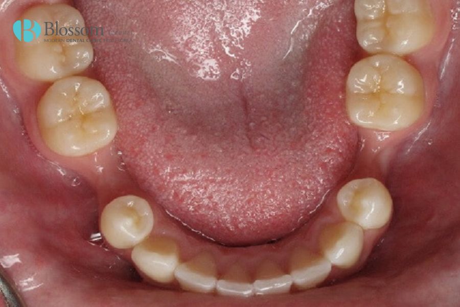 Chi phí của việc điều trị mất răng hàm lâu năm phụ thuộc vào nhiều yếu tố