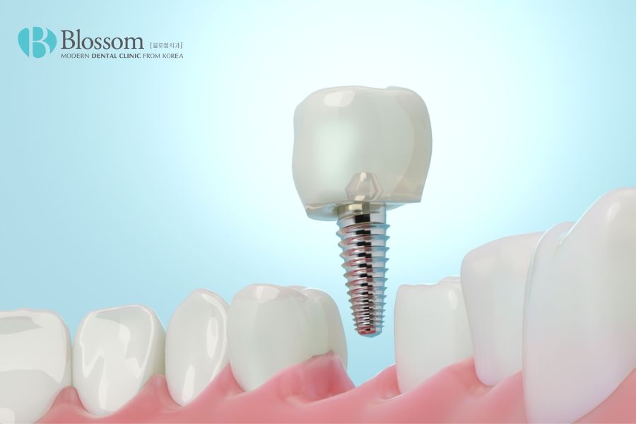 Chi phí trồng răng Implant là một trong những yếu tố cần quan tâm trước khi thực hiện cấy ghép