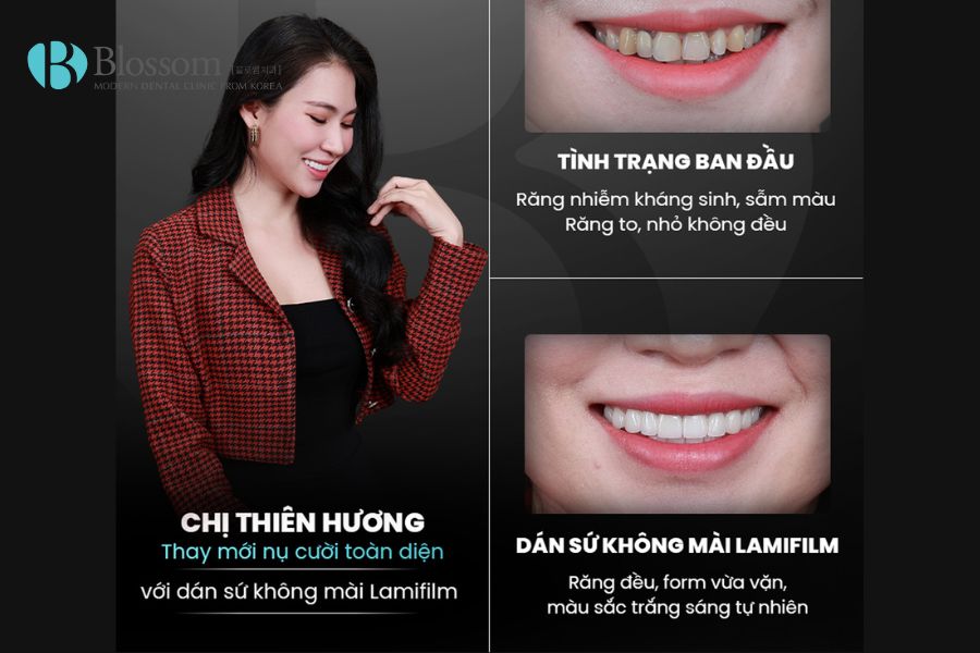 Chị Thiên Hương lấy lại nụ cười rạng rỡ với hàm răng đều, trắng sáng tự nhiên