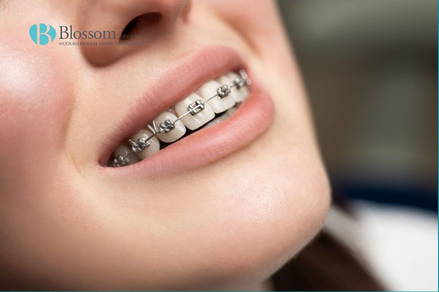 Chỉnh nha là từ chuyên ngành nha khoa tập trung vào việc điều chỉnh vị trí của răng và xương hàm.
