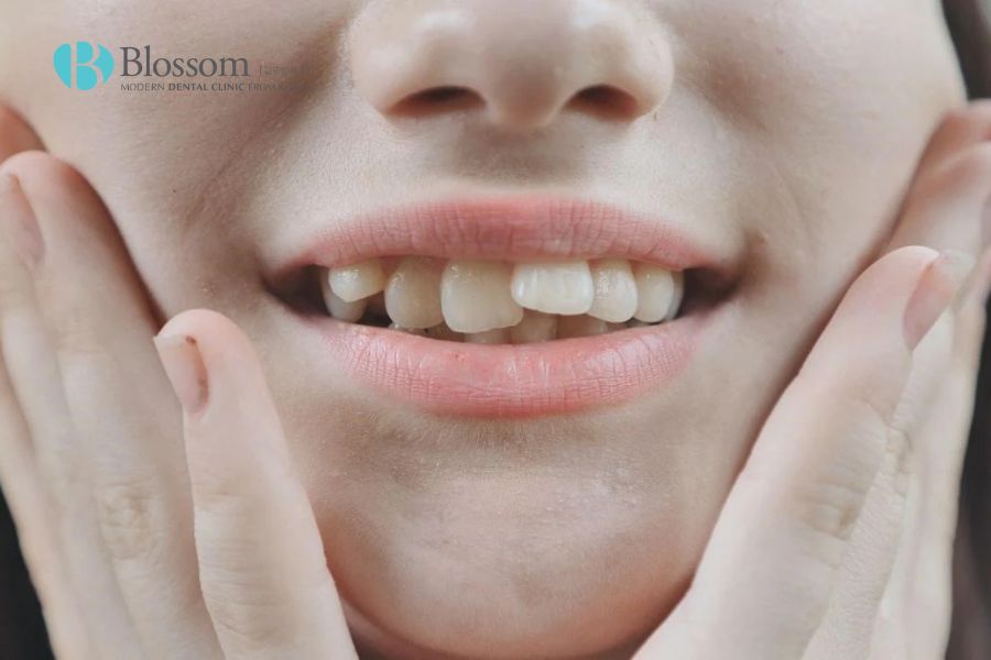 Có nhiều nguyên nhân có thể gây nên tình trạng răng cửa mọc lệch.