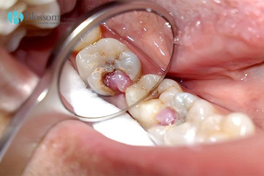 Cơn đau răng xuất hiện dai dẳng, cả ban ngày và ban đêm là dấu hiệu của viêm tủy mãn tính