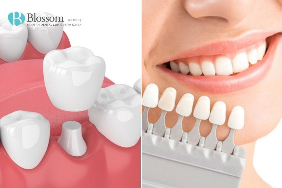 Dán răng sứ hay bọc răng sứ đều có tuổi thọ tương đương nên để kéo dài độ bền cần chăm sóc răng đúng cách