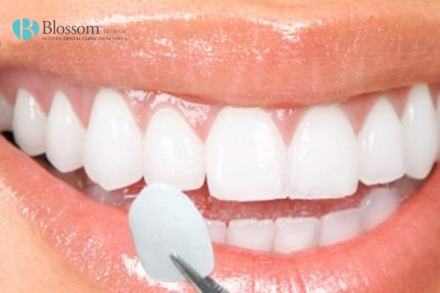 Dán răng sứ là phương pháp gắn cố định miếng sứ mỏng lên răng thật khoảng 0.2 - 0.5mm