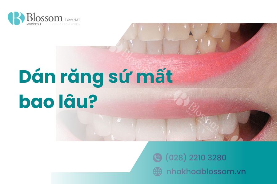 Dán răng sứ mất bao lâu? Giải đáp từ Nha Khoa Blossom