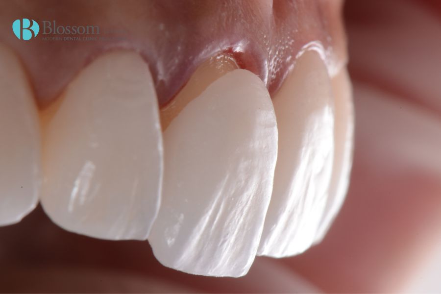 Dán sứ cho răng cửa thường sẽ nhanh hơn dán răng hàm