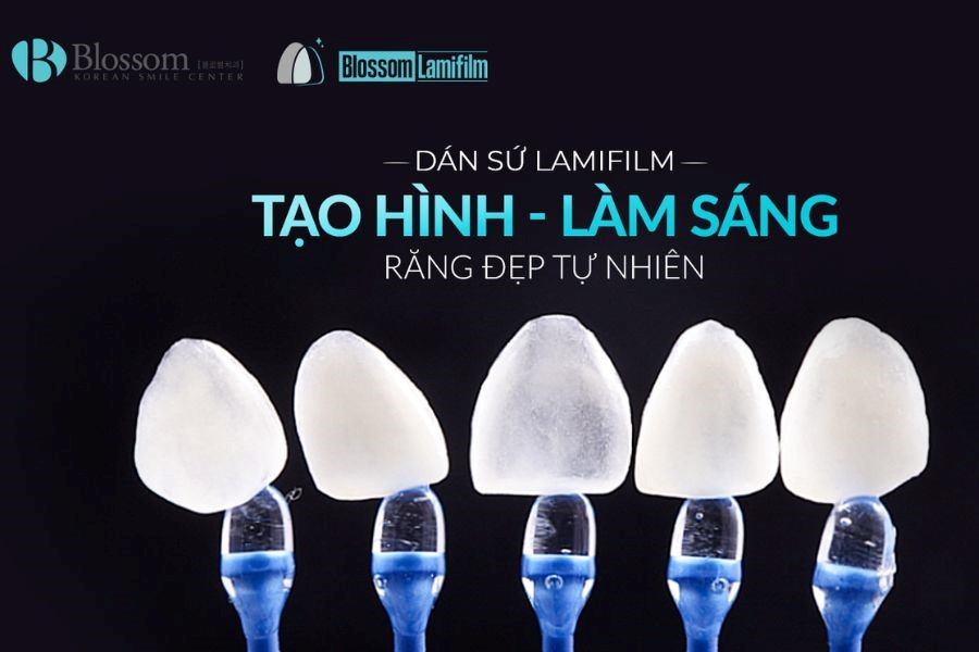 Dán sứ không mài Lamifilm là công nghệ tạo hình răng sứ tiên tiến bậc nhất hiện nay.