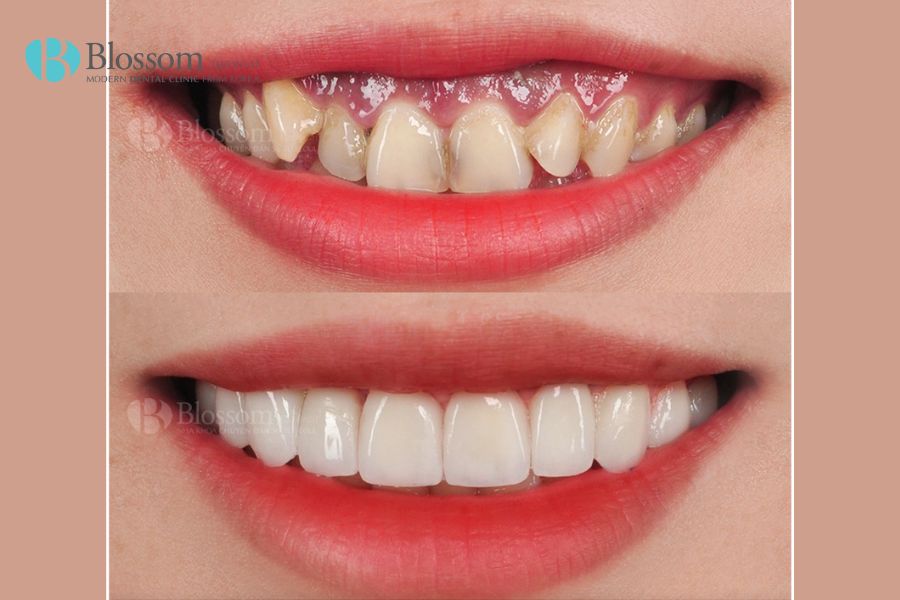 Dán sứ Lamifilm không mài - Phương pháp phục hình răng hiệu quả, không gây đau đớn tại Nha Khoa Blossom