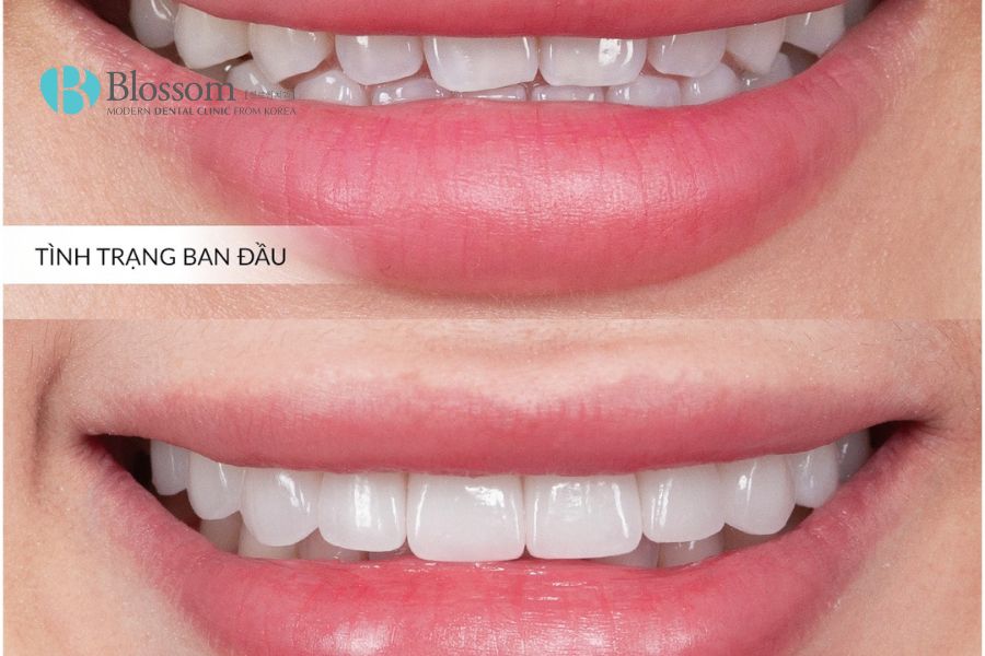 Dán sứ Lamifilm là công nghệ phục hình răng thẩm mỹ tiên tiến bậc nhất hiện nay.