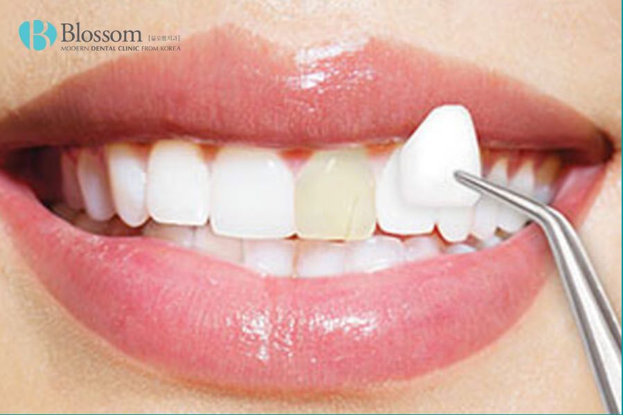 Dán sứ Veneer cũng là phương pháp thẩm mỹ cho răng bị nhiễm fluor nặng.