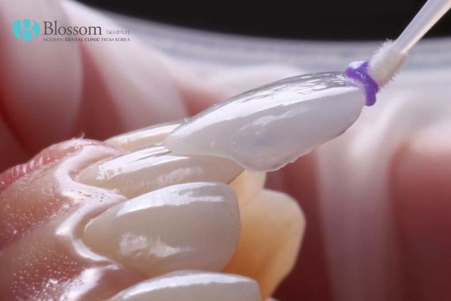 Dán sứ Veneer Emax mang tính thẩm mỹ cao, giải quyết hiệu quả các khuyết điểm của răng