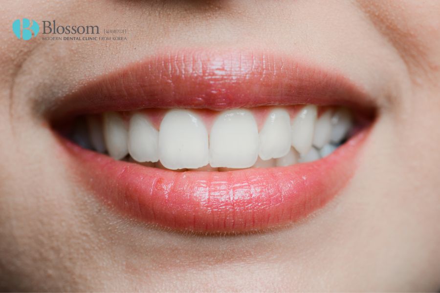 Dán sứ Veneer là phương pháp phục hình răng hiện đại, mặt dán sứ có độ dày twf0.3 - 0.5 mm